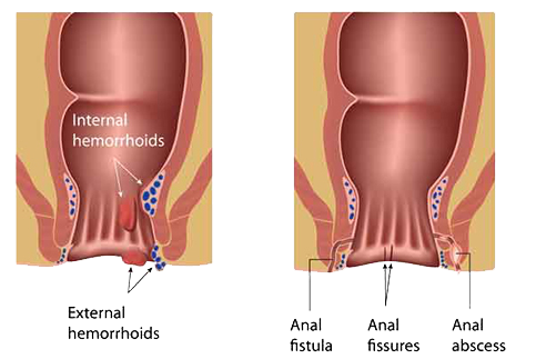 Pilestreatmenthyderbad Dr. Ganga Shanker