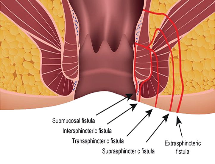 fistula Dr. Ganga Shanker