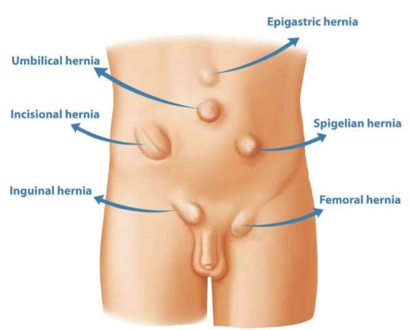 HERNIAL TREATMENTS IN SUCHITRA HYDERBAD